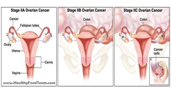 10 signes d'alerte précoce du cancer des ovaires Vous ne devriez pas ignorer
