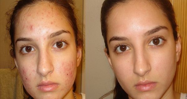 Essayez ce mélange de bicarbonate de soude pour les soins du visage!