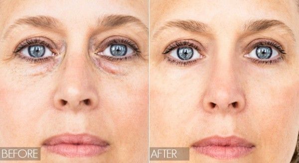 Comment se débarrasser des poches des yeux rapidement et naturellement en quelques jours