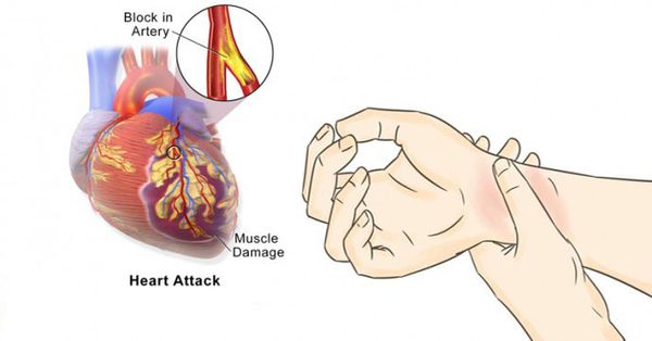 80% des crises cardiaques pourraient être évités si tout le monde fait ces 5 choses faciles