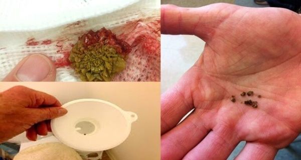 Surveillez votre PIERRES REINS sortir avec ce remède à la maison!