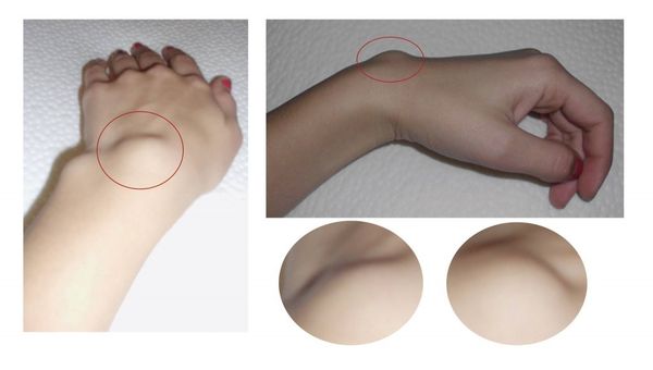 Comment traiter les morceaux de peau connus comme lipomes? Retirez-les Naturellement!