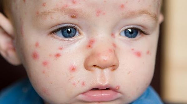 En Plus Du Traitement Médical, 5 Ingrédients Naturels L'utiliser Pour Traiter Les Maladies De La Varicelle ,, FAITES CELA !!!