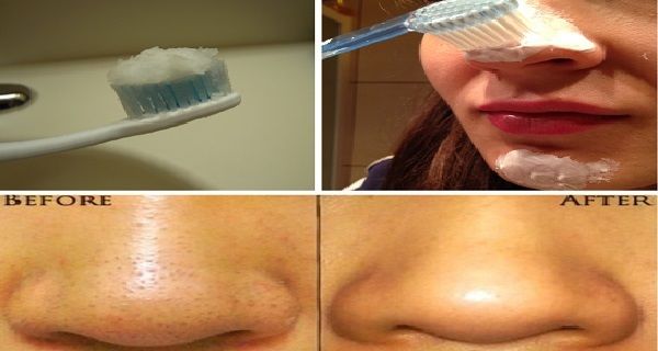 Une méthode qui fonctionne vraiment: Utilisez brosse à dents et se débarrasser des points noirs Immédiatement!