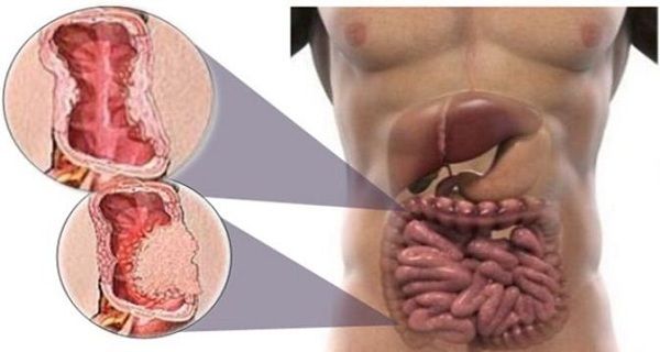 90% de toutes les maladies commencent dans la Colon! Voici ce que vous pouvez faire pour les éviter et protéger votre corps!