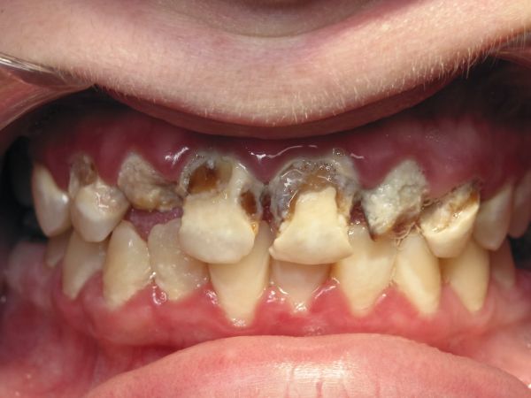Dents détruits par l'acide phosphorique dans les sodas - vidéo CHOQUANTE