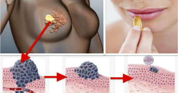 La vitamine D peut arrêter la croissance des cellules du cancer et nous en avons besoin beaucoup plus que les Docteurs pensent