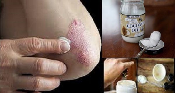 Utilisez l'huile de coco pour traiter l'eczéma - Les résultats sont incroyables!