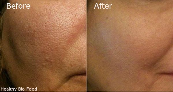 Remèdes naturels pour les pores dilatés