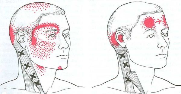 Si vous avez un manque de cette vitamine Le risque de migraines fréquentes sera augmenté de 300%