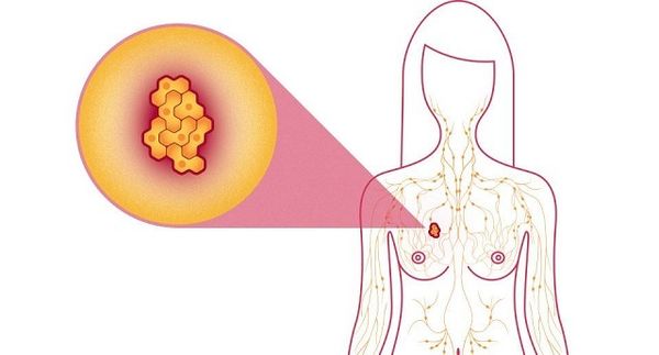 6 super aliments qui peuvent tuer complètement le cancer du sein