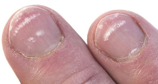 Voici ce que les lignes blanches sur vos ongles Représentent