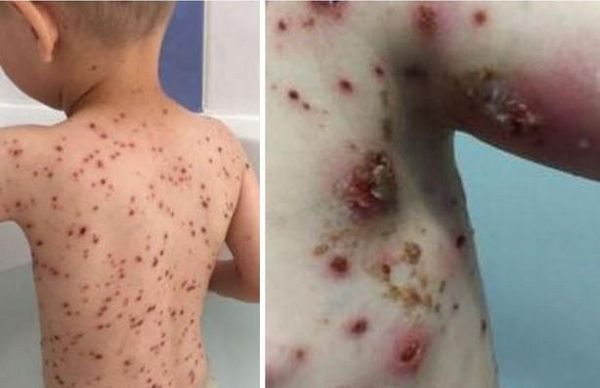 Cette mère alerte sur les dangers de donner de l'Ibuprofène à vos enfants souffrant de varicelle