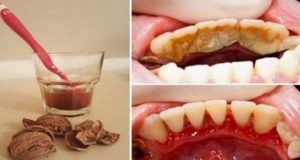 Se débarrasser de la Plaque des dents, Tartare et Saignement des gencives dans une manière très simple et facile sans douleur