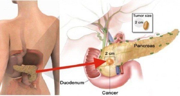 Manger seulement 2 morceaux de ceci augmente votre risque de cancer du pancréas