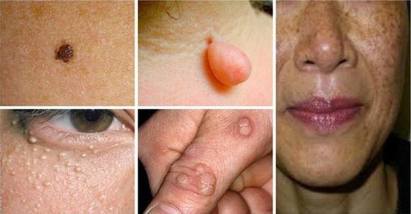 Moyens naturels pour détruire Moles, Verrues, comédons, Tags de la peau et les taches de vieillesse