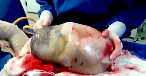 A VOIR ABSOLUMENT: un moment rare ou un bébé est né à l’intérieur d’un sac amniotique intact