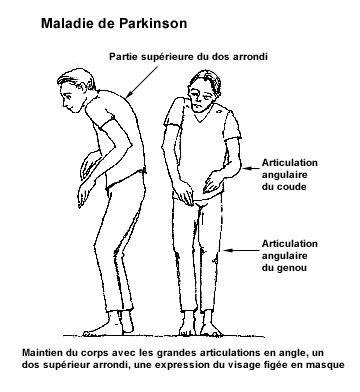 QU’EST-CE QUE la maladie de Parkinson ?