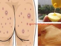 Comment se débarrasser de l'acné sur les fesses avec des remèdes naturels