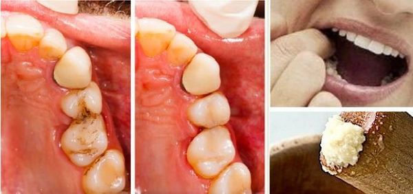 Guérissez les caries par vous-même et dites adieu à la douleur !