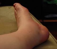 Éliminer enflure des jambes avec cette façon naturelle !!