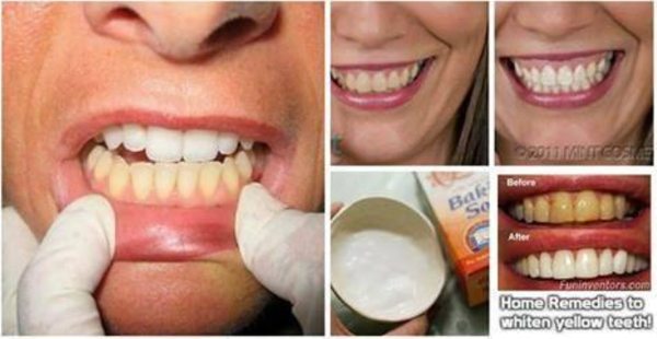 3 plus puissants remèdes maison pour les dents jaunes qui fonctionne merveille dans quelques jours!