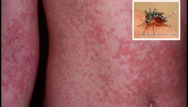 5 CHOSES QUE VOUS DEVEZ SAVOIR SUR LE NOUVEAU VIRUS GLOBAL APPELÉ ZIKA