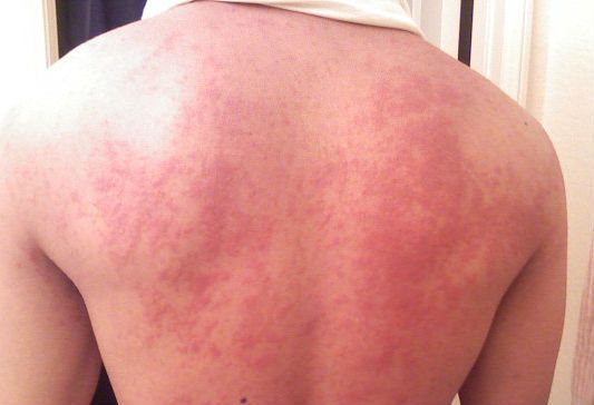 5 CHOSES QUE VOUS DEVEZ SAVOIR SUR LE NOUVEAU VIRUS GLOBAL APPELÉ ZIKA