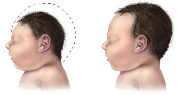 médecins argentins et brésiliens nommer larvicide comme cause potentielle de microcéphalie