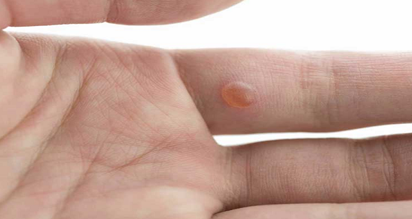 7 signes précoces de cancer du poumon auxquels vous devez rester attentifs !