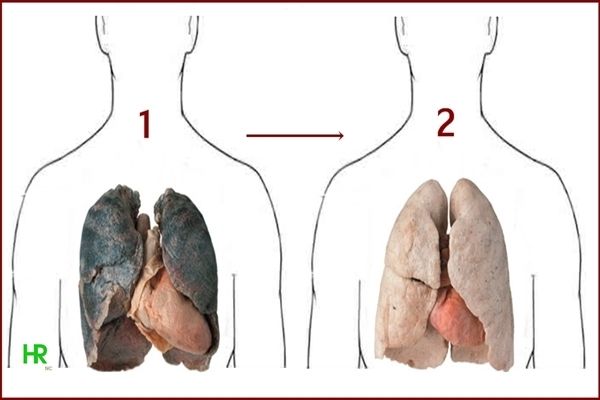Les fumeurs devraient lire ce: Ces 4 ingrédients peuvent nettoyer votre Poumons De nicotine et de goudron