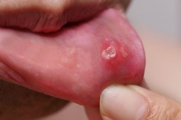 Get Rid Of aphtes With No Medicine!