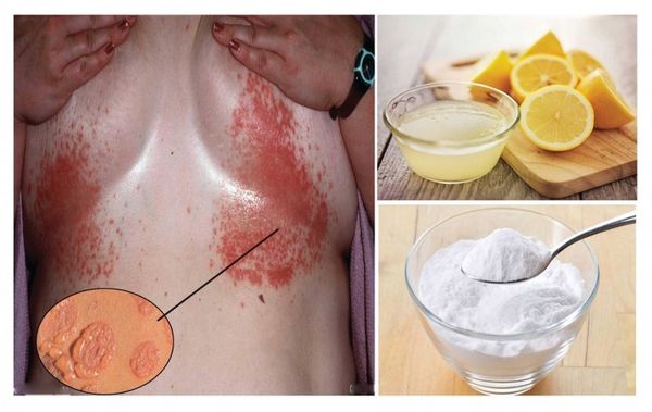 Vous avez Éruptions sous vos seins ?! Vous devriez utiliser Remède naturel de bicarbonate de soude et de jus de citron!