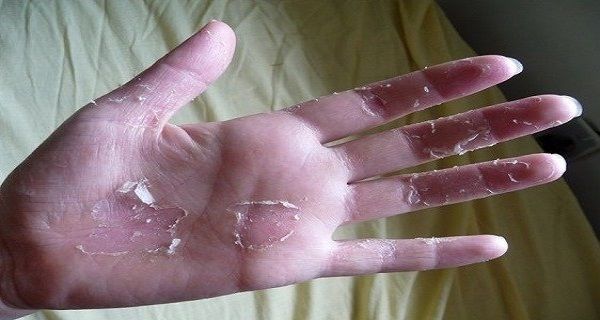 Est-ce que la peau de vos mains Peeling? Si oui, alors voici ce que vous devez faire!