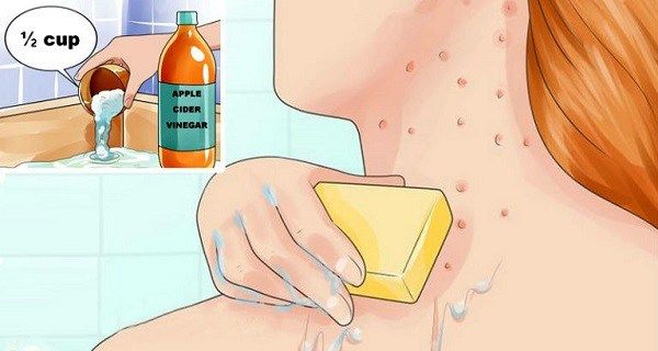 Mettez du vinaigre de cidre sur votre visage et voir ce qui arrive à Toxines, Eczéma et taches de vieillesse