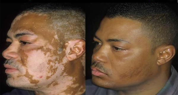 Le Monde entier célèbre cette Nouvelles: Médecins Cure Pour Vitiligo. Connaître les détails