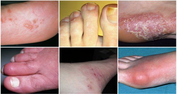 Prendre un bon aperçu à vos pieds: ces 10 signes peuvent indiquer un problème de santé graves