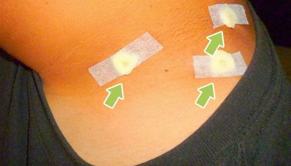 LES BLESSURES CAUSÉES PAR LE VIRUS DU PAPILLOME HUMAIN ET REMÈDES MAISON