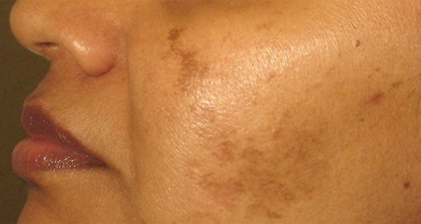 Se débarrasser des taches, taches de rousseur et l'hyperpigmentation, en utilisant cette recette naturel qui contient 2 ingrédients