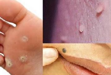 Comment guérir naturellement la peau Tags, Moles, Verrues, points noirs, et des taches de vieillesse