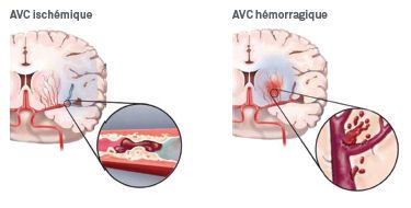 AVC ischémique ou hémorragique ?