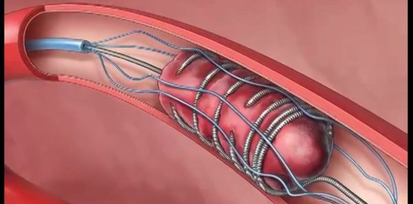 Et la thrombectomie ?