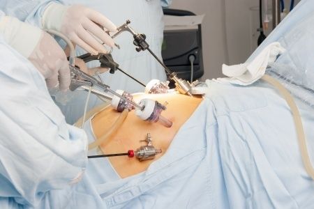 Operacion de vesicula por laparoscopia postoperatorio
