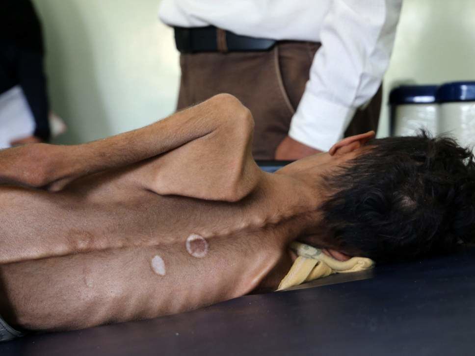 Yemen famine (c) AFP Getty images