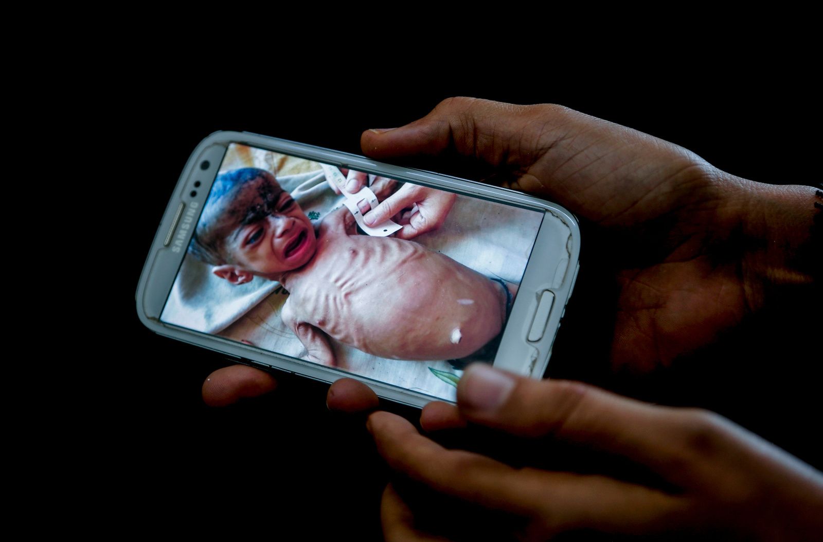 Yemen famine (c) Nariman El-Mofty AP