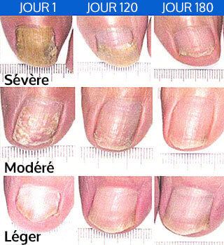 champignons des ongles de pieds champignons des ongles de pieds