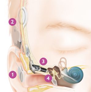 Appareil auditif totalement implantable Carina, vidéo de présentation -  Tout sur l'audition, la surdité et les appareils auditifs