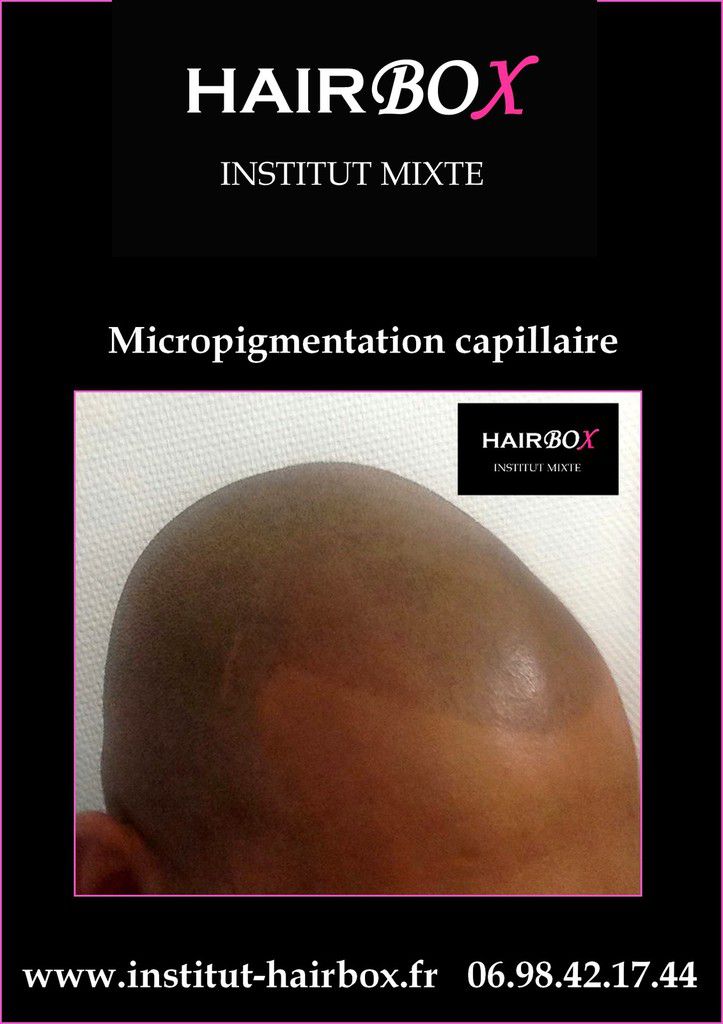 Micropigmentation capillaire / Tricopigmentation