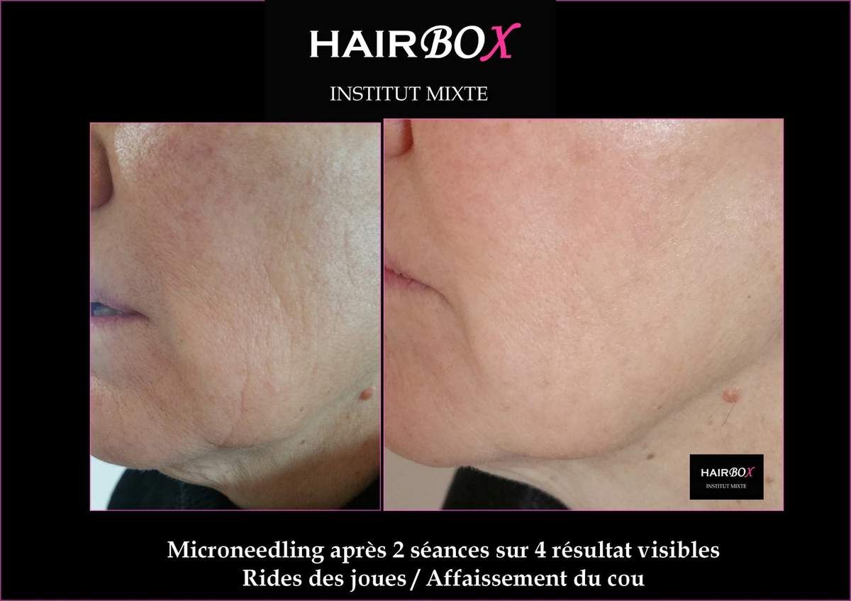 Microneedling - INSTITUT HAIRBOX