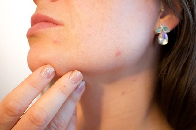 Les causes de boutons d'acné chez l'adulte sont nombreuses. Il est cependant essentiel de prendre soin de sa peau avec un produit adapté à son âge.